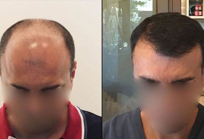 bestfue-hair-transplantaion