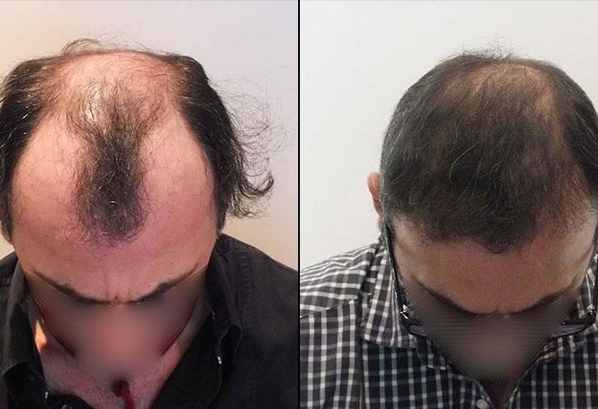 bestfue-hair-transplantaion