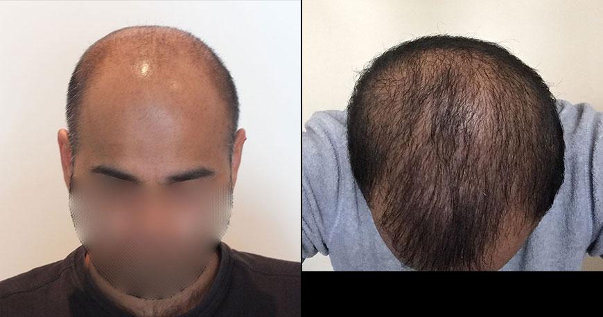 Erfahrungen haartransplantation - 🧡 Hair transplant Cz. 