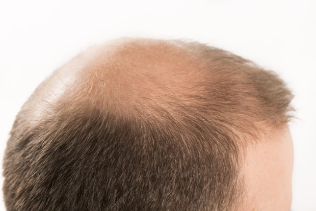 hair loss men