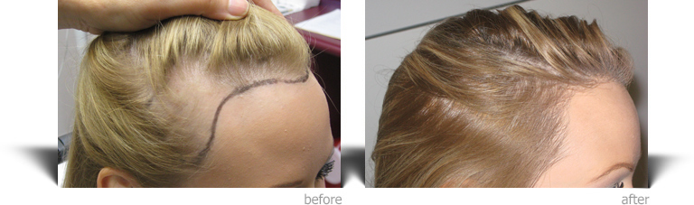 Hair transplant for women - Haartransplantation für Geheimratsecken und  Glatzen
