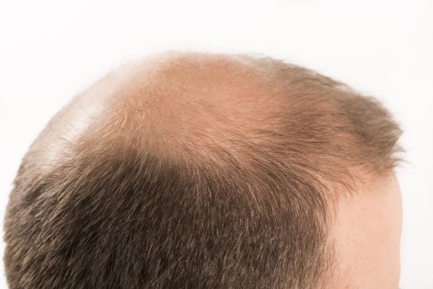 Hair loss by men - Haartransplantation für Geheimratsecken und Glatzen
